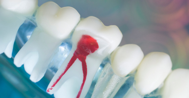 Root Canal Therapy Levels Up Once Again