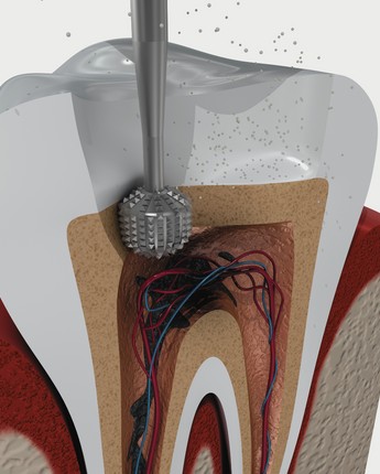 Root Canal Therapy