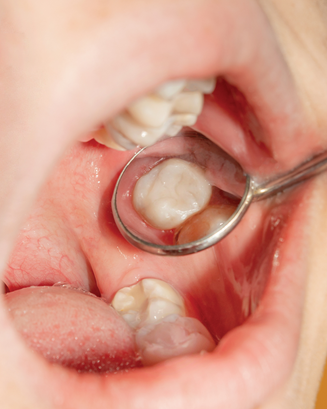 Fillings & Restorations